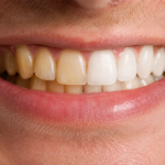 Brasssmile